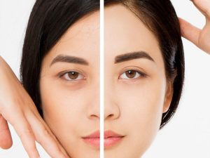 جراحی لیفت شقیقه - دکتر فرخ کامران خواجوی تهران