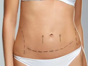 رنوویون همیشه با لیپوساکشن همراه است؟ - دکتر فرخ کامران خواجوی