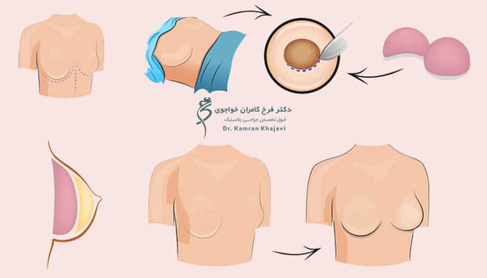 روند جراحی ترمیم پروتز سینه