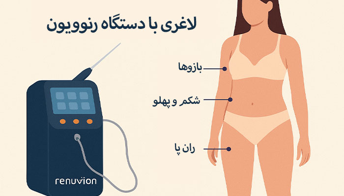 لاغری با دستگاه رنوویون