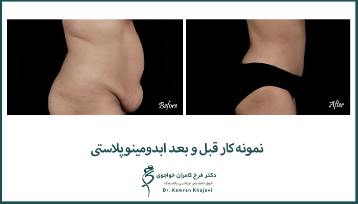 نمونه کار ابدومینوپلاستی دکتر فرخ کامران خواجوی