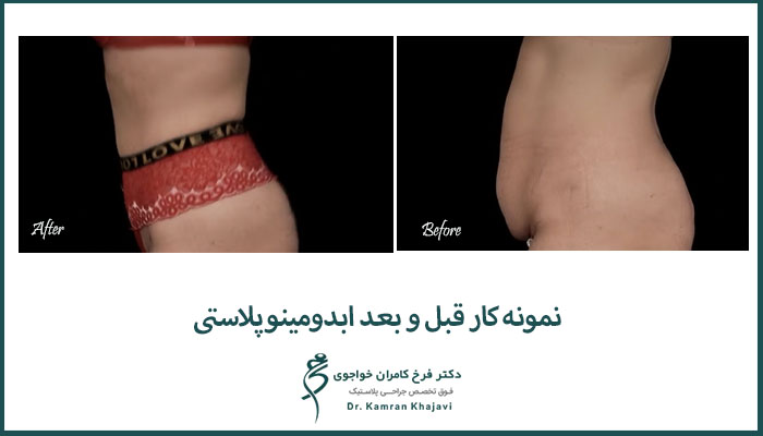 نمونه کار ابدومینوپلاستی دکتر فرخ کامران خواجوی