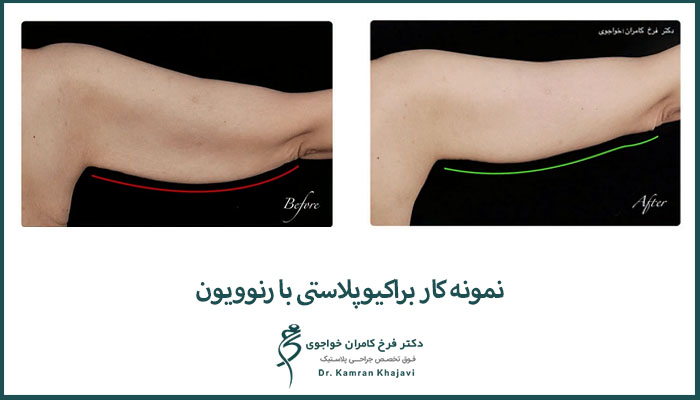 نمونه کار براکیوپلاستی با رنوویون