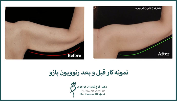 نمونه کار براکیوپلاستی با رنوویون2