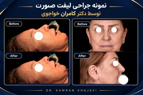 نمونه کار لیفت صورت کامران خواجوی