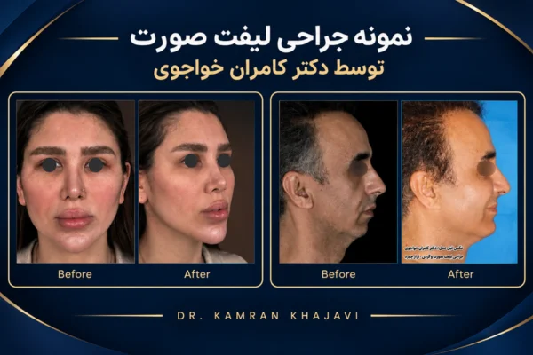 نمونه جراحی لیفت صورت دکتر خواجوی در تهران 